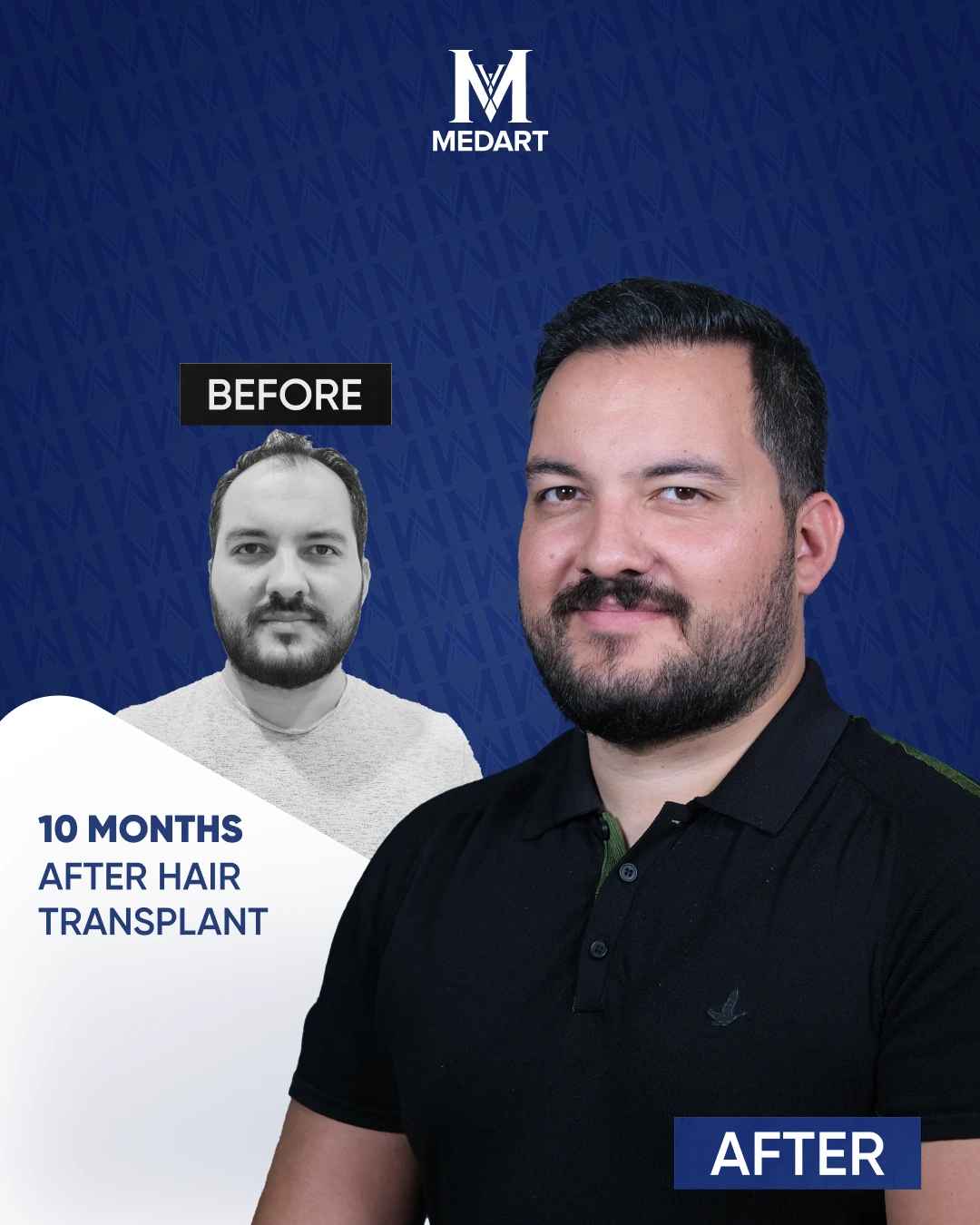 DHI Hair Transplant Results