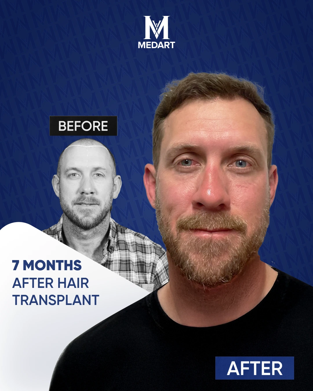 DHI Hair Transplant Results
