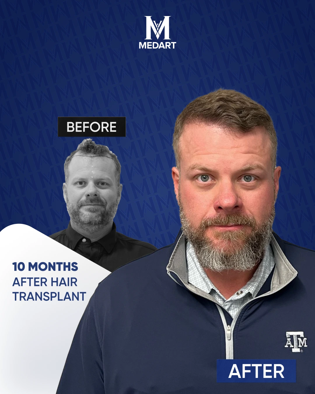 DHI Hair Transplant Results
