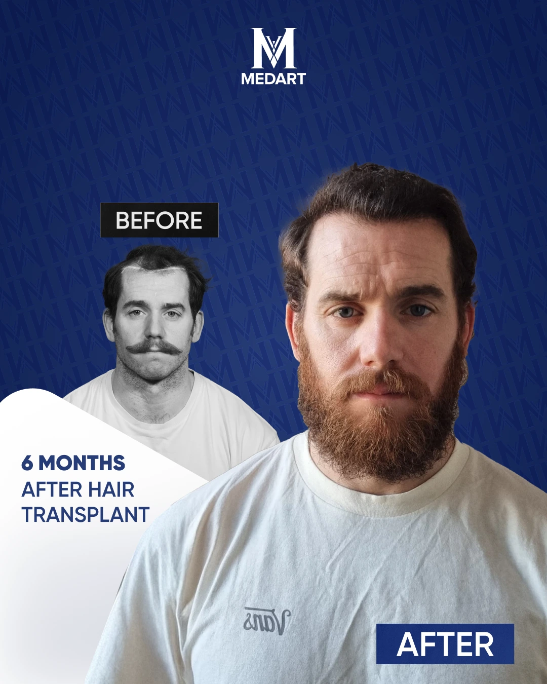 DHI Hair Transplant Results