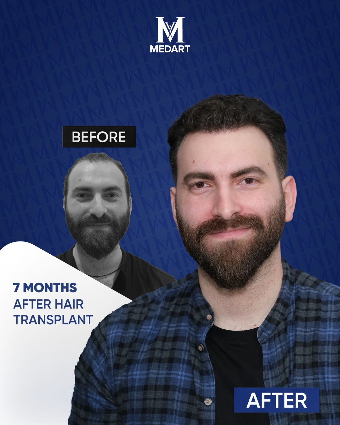 Sapphire Hair Transplant Results