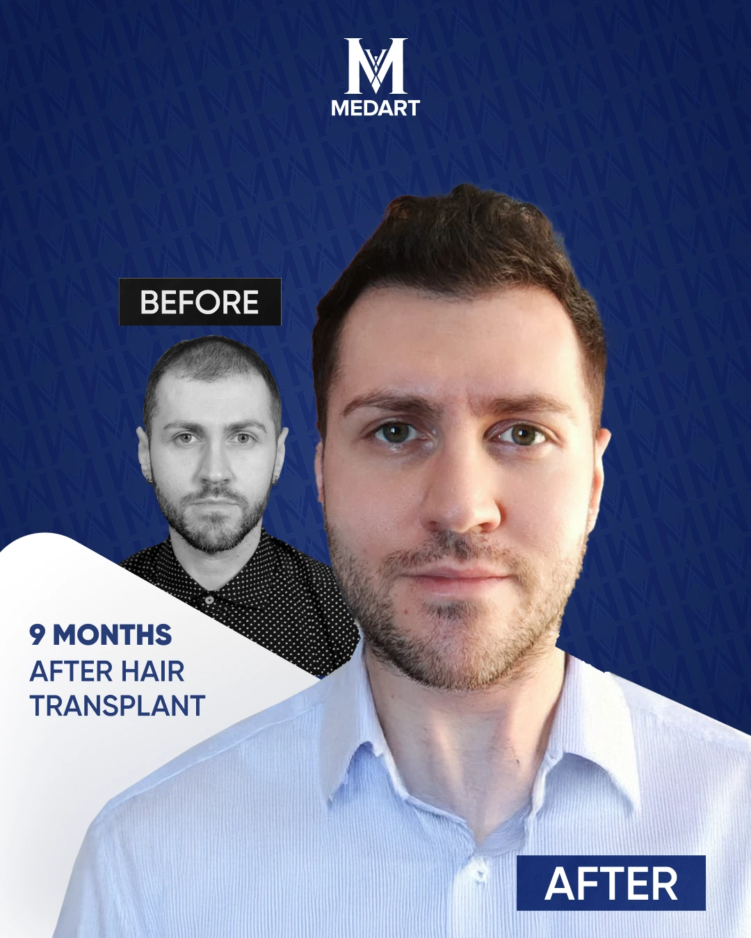 Sapphire Hair Transplant Results
