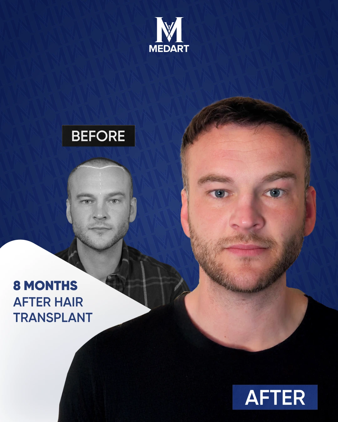 Sapphire Hair Transplant Results
