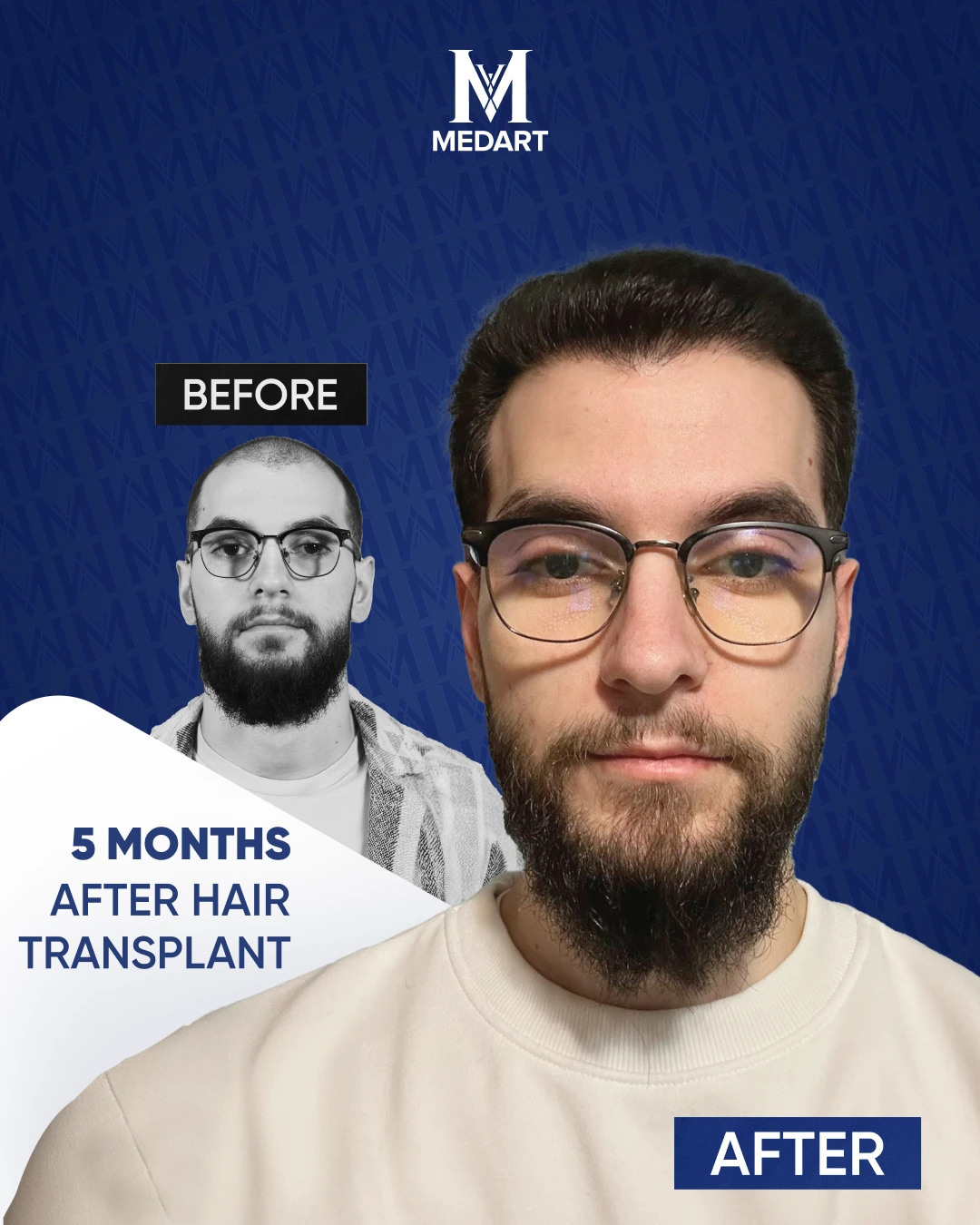 Sapphire Hair Transplant Results