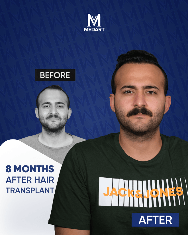 Before After 2